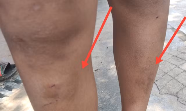 Ném đá văng vào nhà hàng xóm, 5 cháu nhỏ bị đánh bầm tím