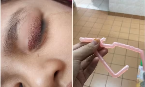 Người mẹ vô ý làm rơi mảnh mắc áo gãy, tai nạn bất ngờ đã xảy ra với cô con gái nhỏ