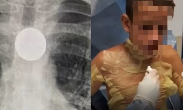 Cô bé 8 tuổi nhập viện khẩn cấp, suýt mất mạng vì bắt chước trò “ảo thuật” trên TikTok