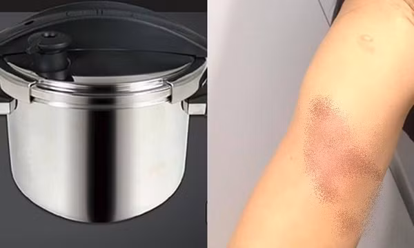 Đang nấu ăn thì nồi áp suất phát nổ: Một người mẹ bị bỏng nặng, em bé 2 tuổi thoát nạn