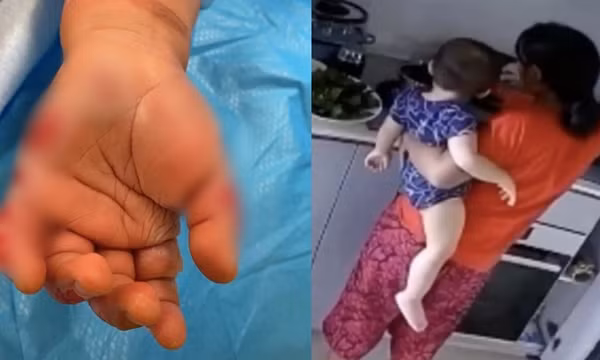 Kinh hoàng cảnh người giúp việc ấn tay em bé 14 tháng tuổi vào nước đang sôi