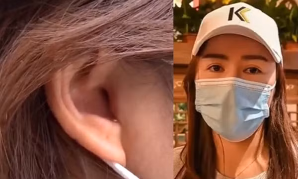 Vào viện thẩm mỹ để sửa mũi, cô gái sốc khi phát hiện ra đã bị cắt mất một phần tai