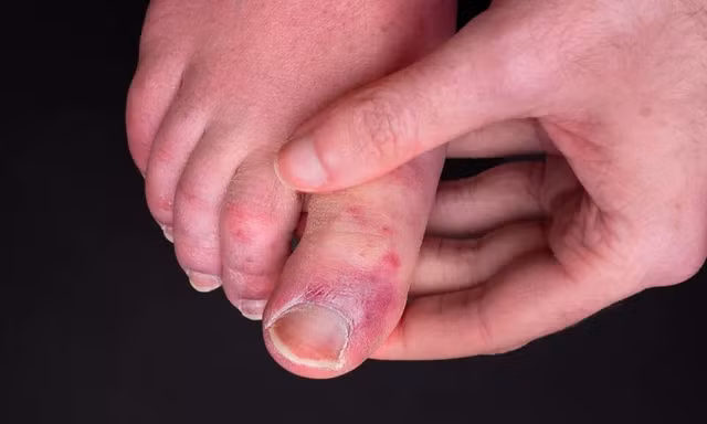 Nhiều người sau khi mắc COVID-19 lại bị phát ban ở ngón chân.