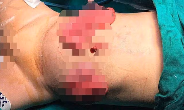 Bé 11 tháng tuổi bị mẹ ruột dùng dao đâm vào bụng