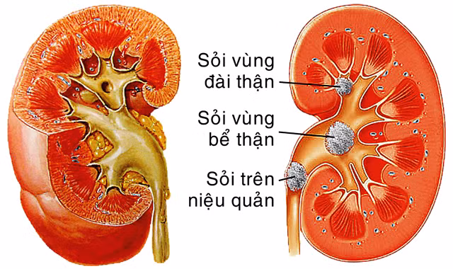 Sỏi thận - Ngăn ngừa tái phát trong điều trị