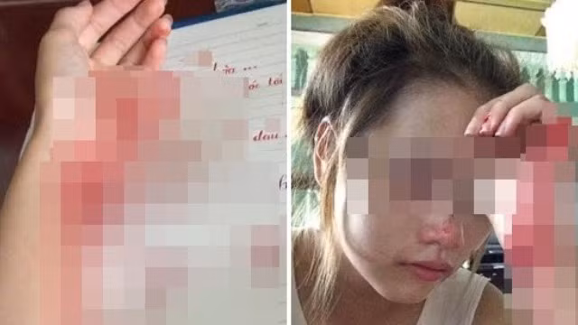Hình ảnh bàn tay đầy máu và khuôn mặt thảm thương của P.K.M.