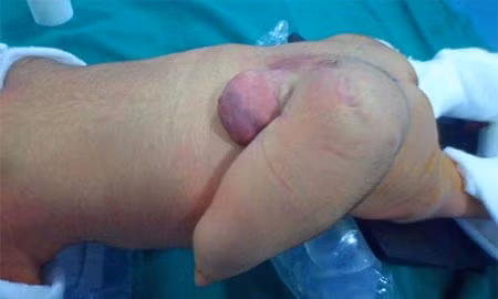 Bé sơ sinh mọc “đuôi” dài 12cm