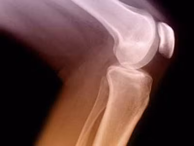 Tiếng kêu ở khớp gối là bệnh gì?