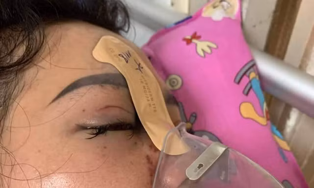 Mù mắt vì tiêm filler nâng mũi từ spa biết trên Facebook