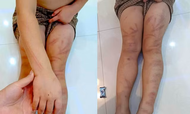 Thông tin mới vụ 6 trẻ mầm non ở Nghệ An bị đánh bầm tím người
