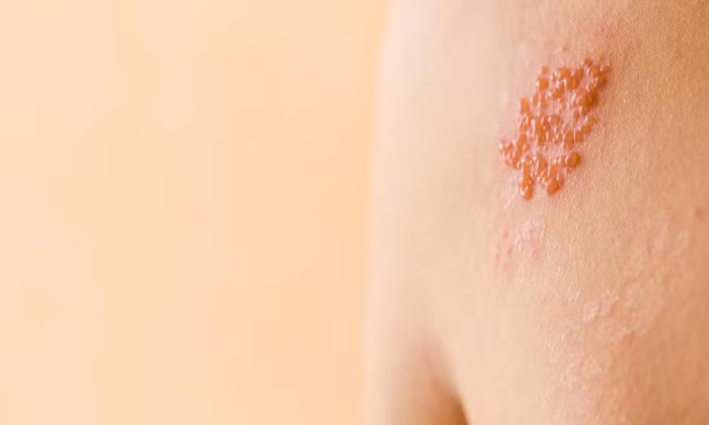 Bệnh Zona thần kinh đang ngày càng trẻ hóa, dễ bị nhầm với tai biến