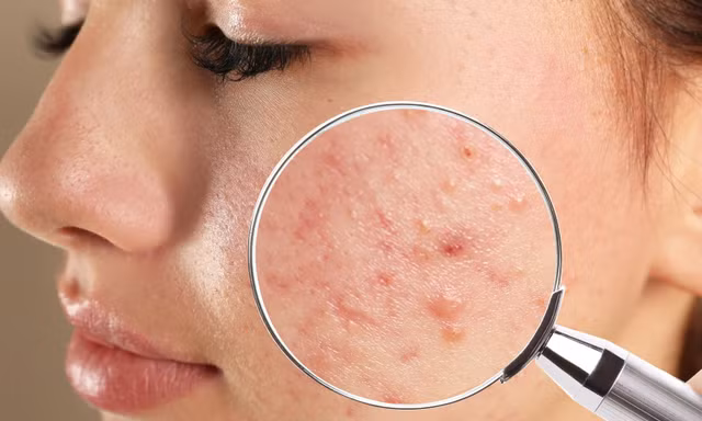 Muốn trị mụn tận gốc phải hiểu đúng về từng loại mụn