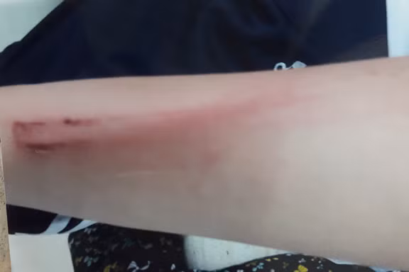 Cô bé 12 tuổi bị cha đánh phải nhập viện vì... 'ham chơi'