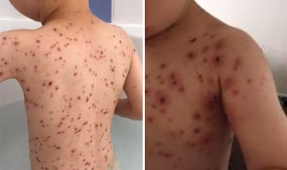 Mùa xuân, cẩn trọng bệnh thủy đậu vào mùa