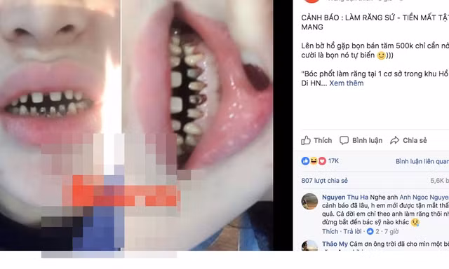  Chị T.N chia sẻ về tình trạng răng sau 2 năm bọc răng sứ.