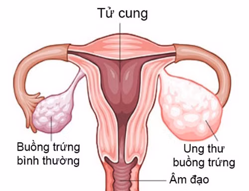 Bạn biết gì về ung thư buồng trứng?