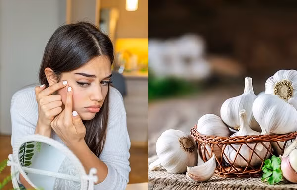 Phương pháp trị mụn bằng tỏi đang "viral" trên Tóp Tóp có thực sự hiệu quả?