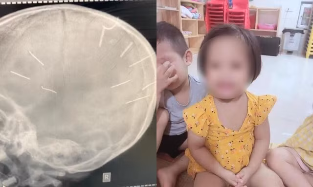 Toàn cảnh vụ bé gái 3 tuổi bị đinh găm vào đầu: Xác định nghi phạm là người tình của mẹ