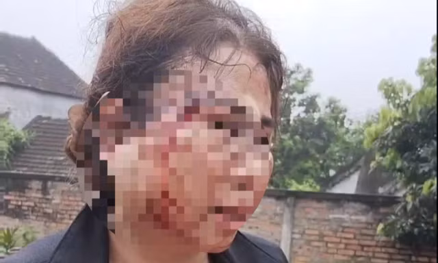 Công an vào cuộc vụ người vợ bị chồng bạo hành nhập viện trước ngày ly hôn