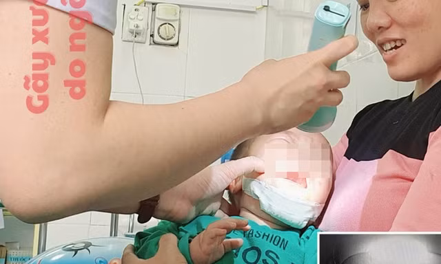 Ngã xe đẩy, bé 10 tháng tuổi bị gãy xương hàm