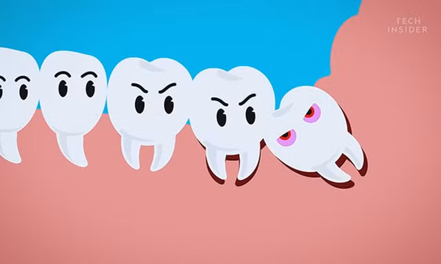 Sự tích răng khôn và vì sao chúng hành hạ con người đến vậy?