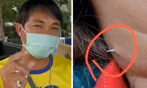 Hóc xương cá nhưng mặc kệ, một người bị cái xương xuyên qua da, “ló” ra ngoài
