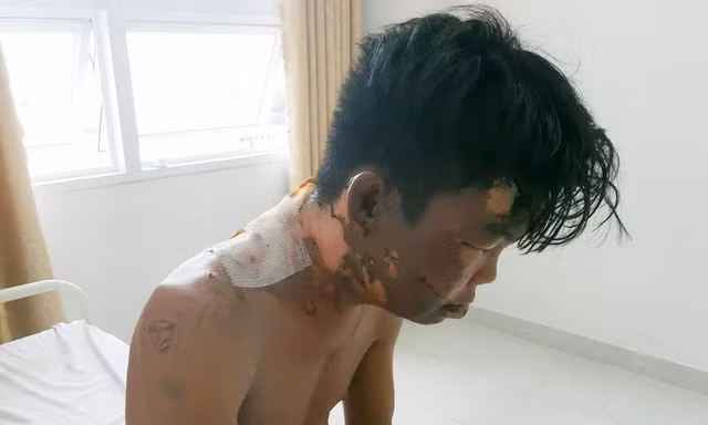 Thanh niên 24 tuổi bị chị gái đổ nồi nước sôi lên đầu