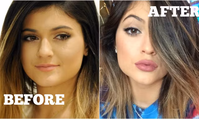 Tại sao mọi người đều tiêm filler làm đầy môi? Những khao khát dấu đằng sau mốt môi dày