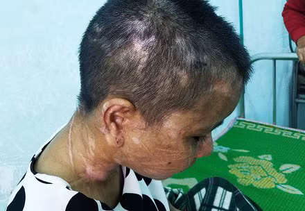 Hàng trăm vết thương từ đầu xuống chân Y Nhiêu