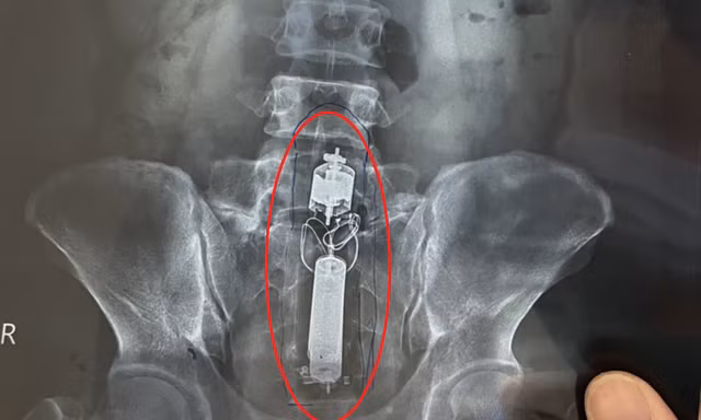 Sextoy kẹt trong trực tràng nam thanh niên.