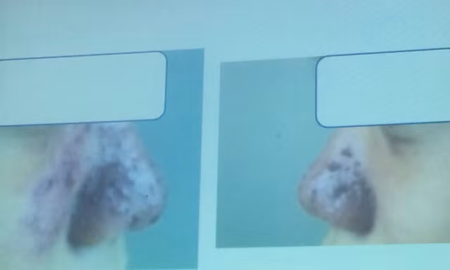 Bỏ ra 1,5 triệu để nâng mũi, hiện tại cô gái trẻ đã tốn hơn 30 triệu để điều trị biến chứng.