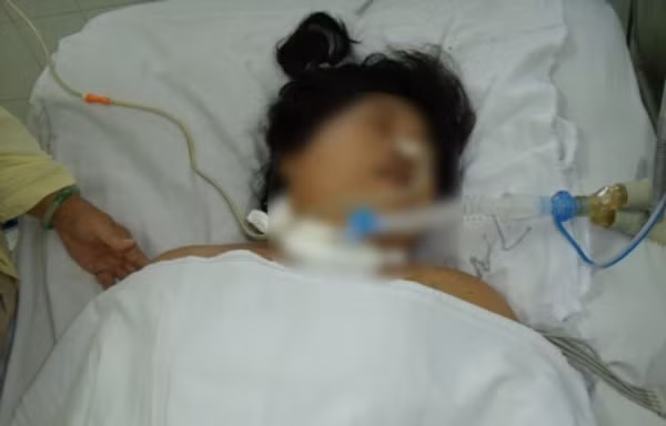 Một trường hợp mắc não mô cầu nguy kịch