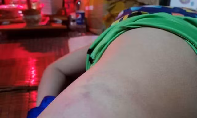 Phụ huynh tố giáo viên chủ nhiệm đánh con mình bầm tím cơ thể. Ảnh: Người nhà đăng tải