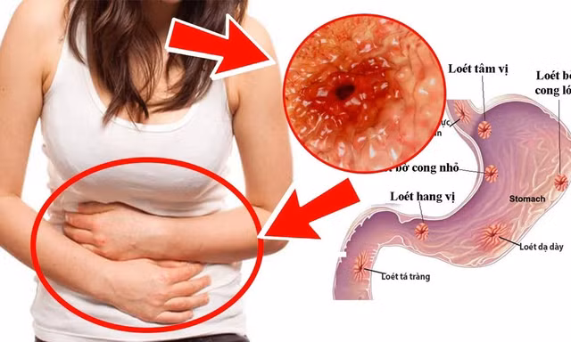 Đau dạ dày gây ảnh hưởng lớn đến người bệnh