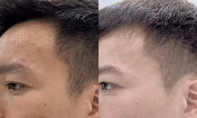 Hành trình hết mụn, sẹo của Hoàng Đức: Khi phong độ và diện mạo cùng tỏa sáng