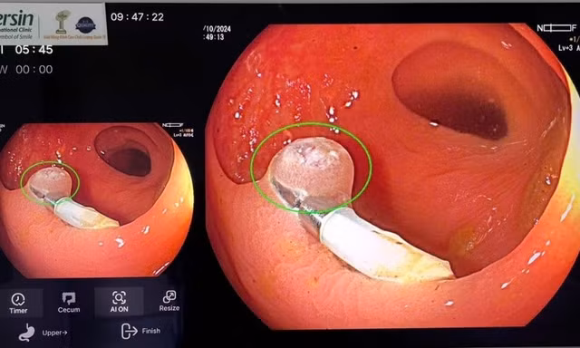 Những khả năng phi thường của A.I trong nội soi tiêu hóa
