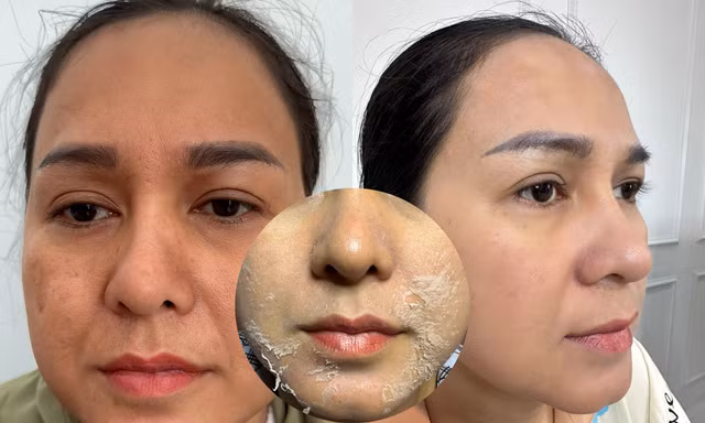 Peel da và những điều cần lưu ý