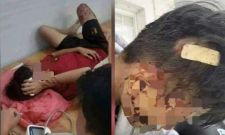 Mâu thuẫn cá nhân, học sinh lớp 8 bị bạn dùng gậy đánh nhập viện