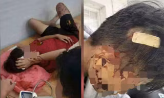 Mâu thuẫn cá nhân, học sinh lớp 8 bị bạn dùng gậy đánh nhập viện