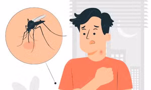 Dịch sốt xuất huyết tăng cao, lưu ý ngay những dấu hiệu nhận biết và cách phòng tránh