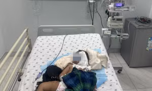 Liên tiếp 2 trẻ bị bỏng nặng trong ngày Tết vì người lớn sơ ý