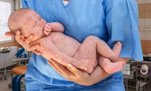 Nguy cơ bùng phát dịch sởi: Những điều cần nhớ để tránh nguy hiểm tính mạng