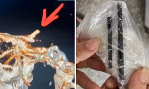 Dân mạng thế giới sốc trước vụ việc một người đàn ông bị mắc đôi đũa trong não