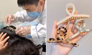 Người phụ nữ bị kẹp tóc ghim vào đầu sau cú ngã, bác sĩ cảnh báo nguy hiểm