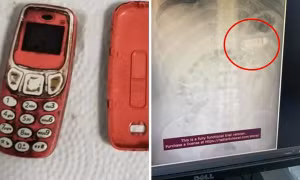 Một bệnh nhân vào viện vì đã nuốt cả chiếc điện thoại Nokia 3310, đến bác sĩ cũng choáng