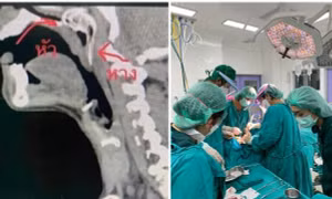 Đang câu cá thì bị cá nhảy luôn vào họng, một người Thái Lan phải phẫu thuật khẩn cấp