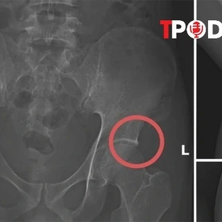 NÓNG 28/11: Vụ dùng búa đục xương để trục lợi bảo hiểm: Hé mở thủ đoạn của Tạ Minh Châu