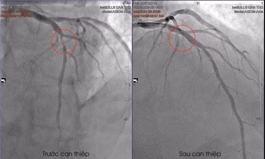 Cứu bệnh nhân quốc tịch Pháp khỏi nguy cơ đột tử ở phút 89