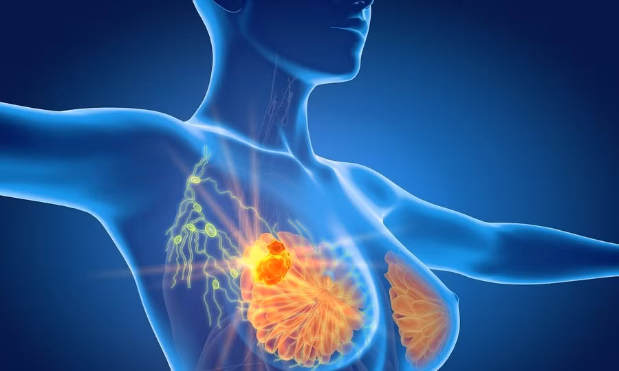 Phát hiện đột biến gen di truyền trên bệnh nhân ung thư vú