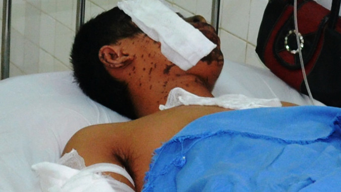 Vết bỏng nặng trên mặt, tay của Thái. Ảnh: Nguyễn Huy